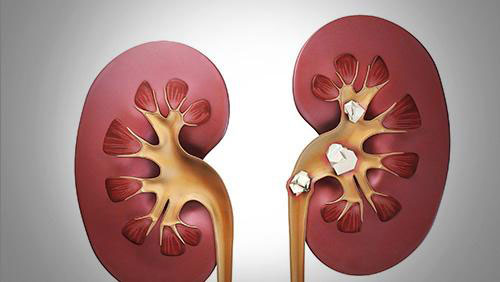 ����ʯ������֢״ ������Щ�����������ʯ